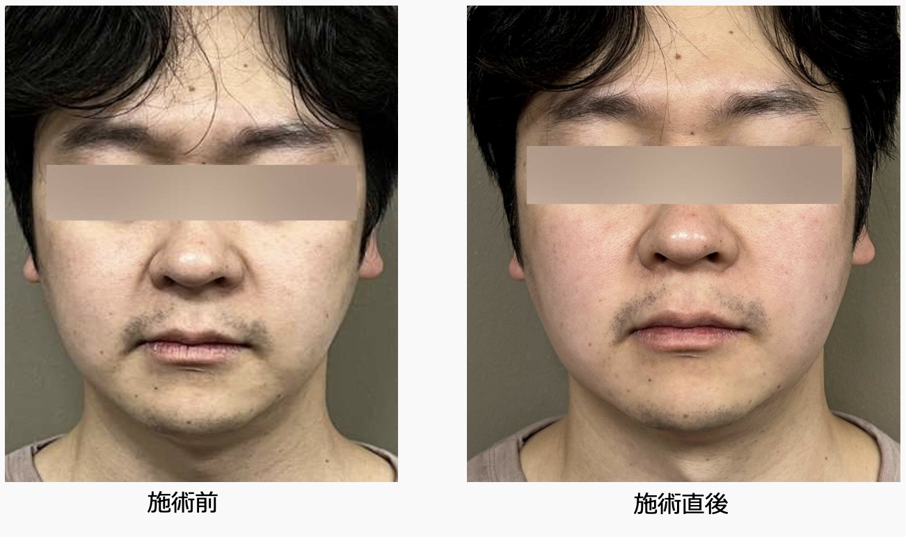 症例1 正面 施術前後比較