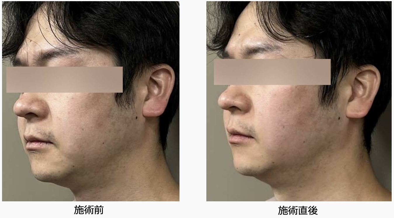 症例1 側面 施術前後比較
