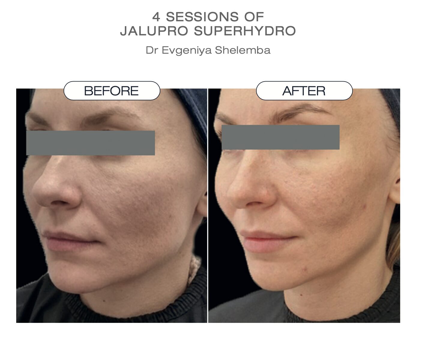 JALUPRO SuperHydro 4回施術後の症例（Dr. Evgeniya Shelemba）