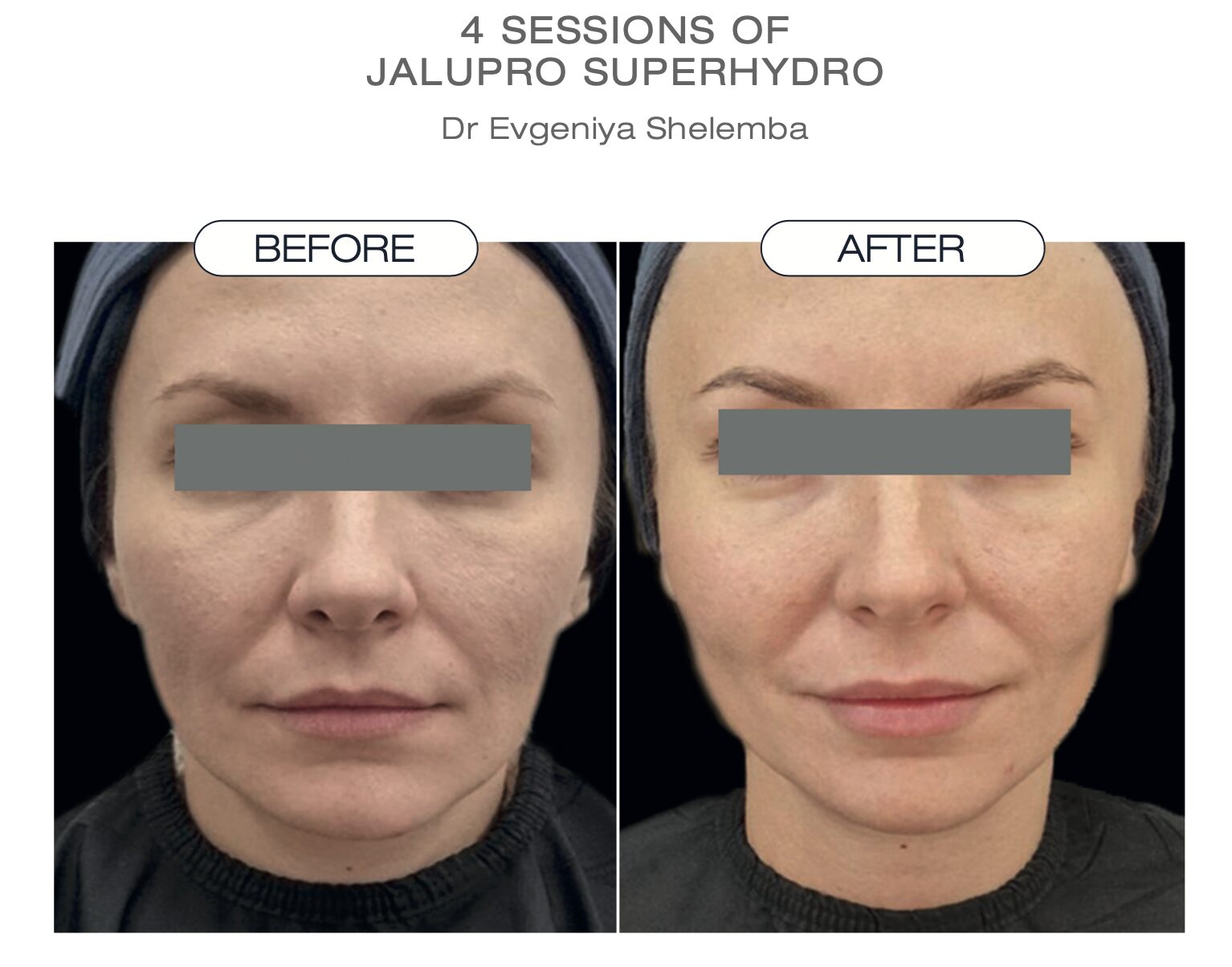JALUPRO SuperHydro 4回施術後の症例（Dr. Evgeniya Shelemba）