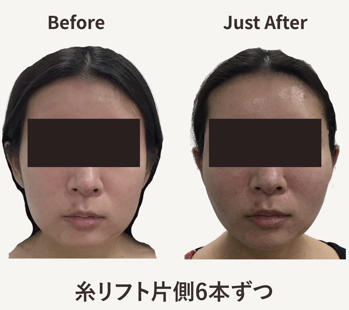 糸リフト 症例写真 Before After 片側6本ずつ
